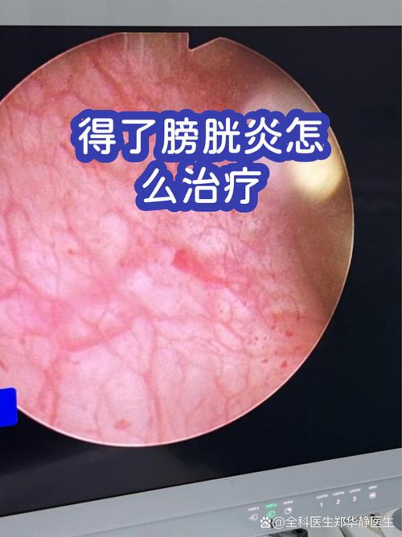 膀胱炎治疗方法